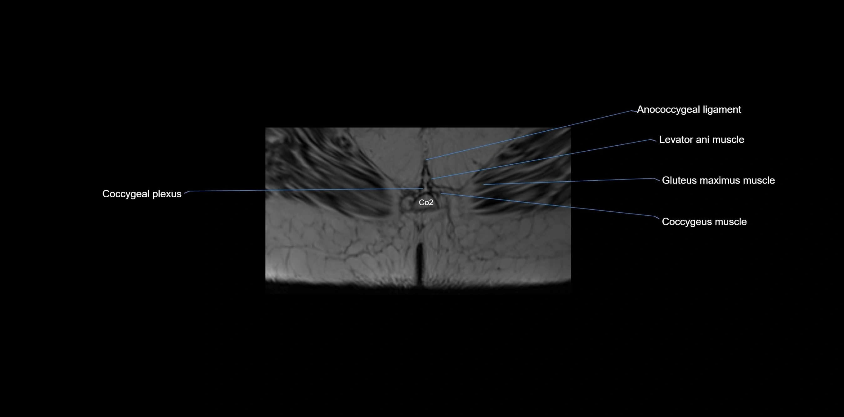 MRI sacrum, coccyx and sacroiliac joint axial cross sectional anatomy 3T  radiology  image-img-00001-00078.webp